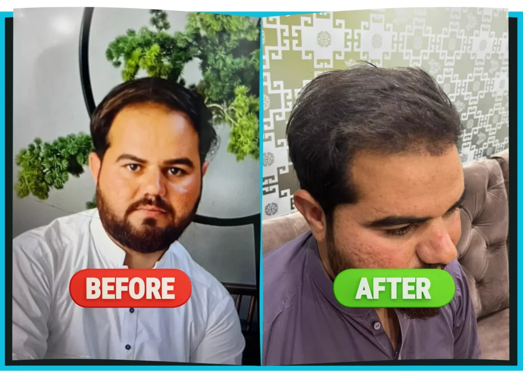 hiarXpert_clinic_results_before_and_after_image03