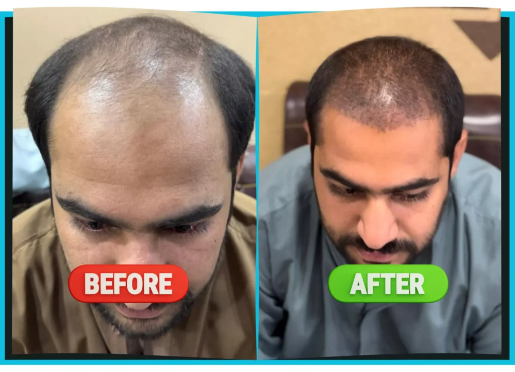 hiarXpert_clinic_results_before_and_after_image04