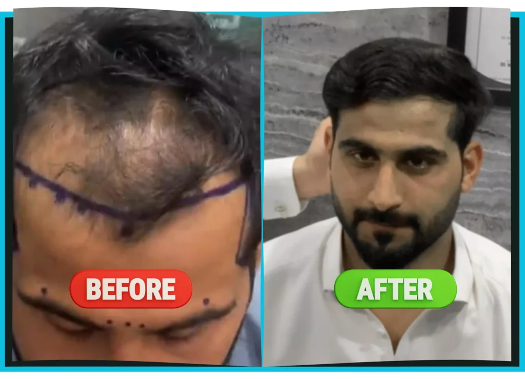 hiarXpert_clinic_results_before_and_after_image05