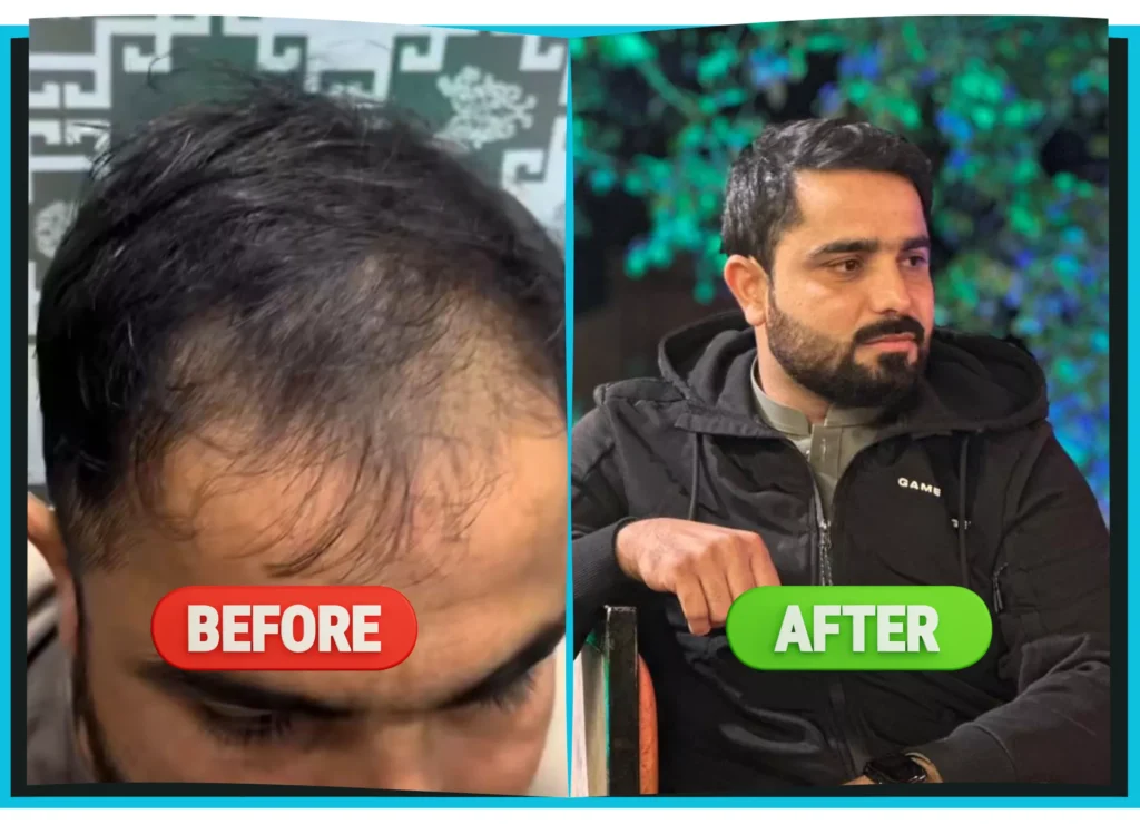 hiarXpert_clinic_results_before_and_after_image07