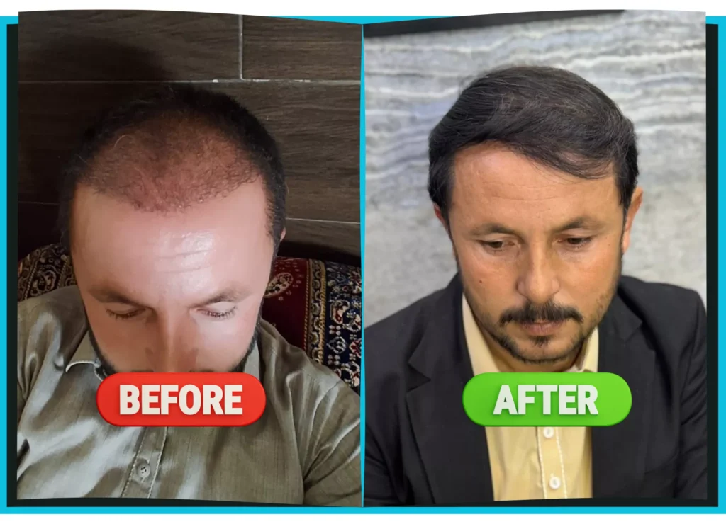 hiarXpert_clinic_results_before_and_after_image08