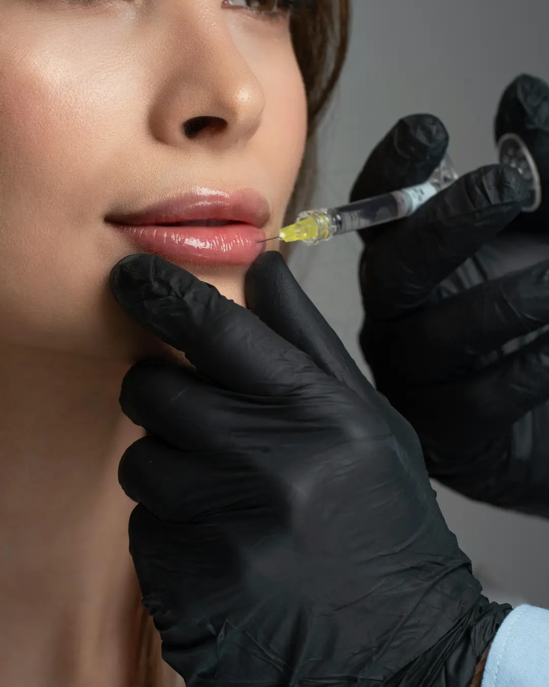 Dermal Lip Fillers 2