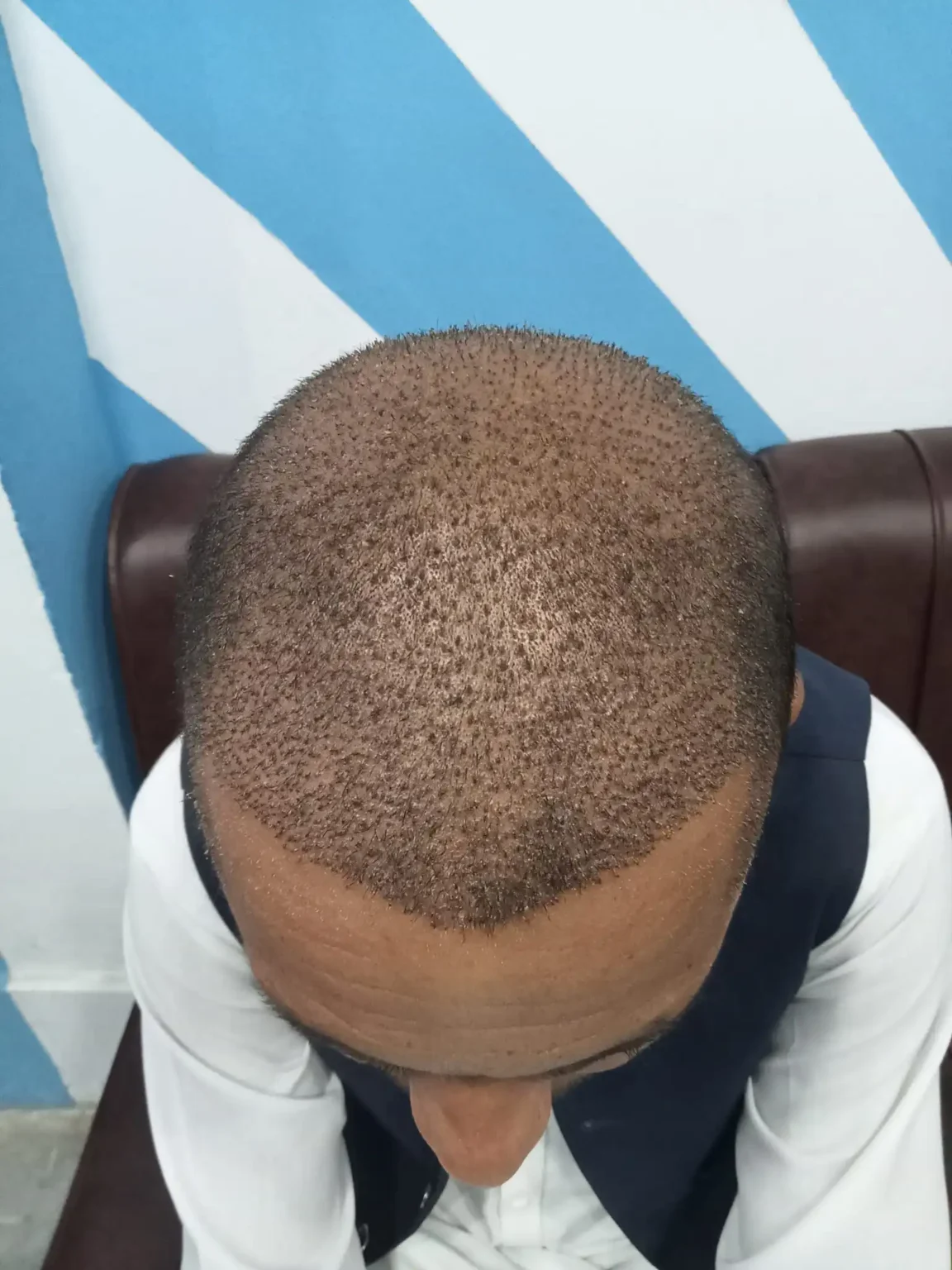 FUE Hair Transplant (Follicular Unit Extraction) 1 What_is_FUE_Hair_Transplant?