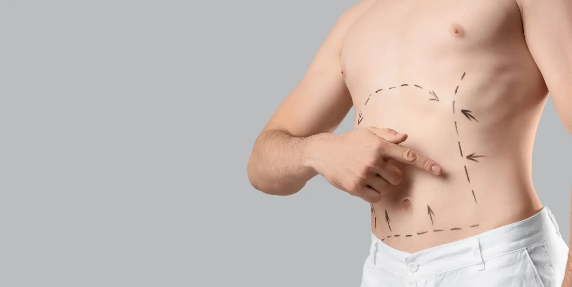 Abdominoplasty (Tummy Tuck Surgery) 3 abdominiplasty 1