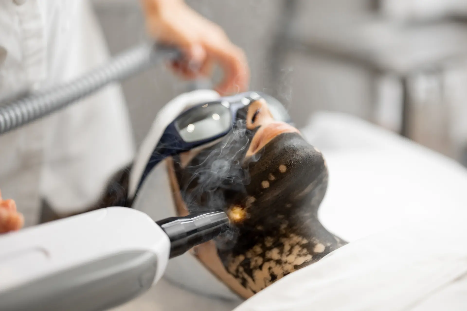 Black Carbon Laser Treatment 3 black corbon laser